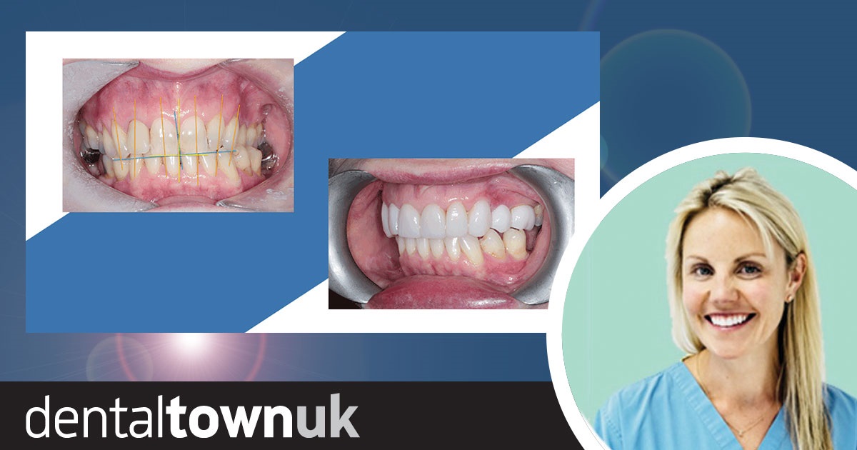 Smile Rehabilitation Dr Heather Cowie presents a comprehensive case study that involves multiple indirect restorations in the conformative occlusal scheme.