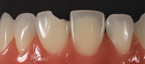 The ‘Blank Canvas’ Technique Dr. Arthur R. Volker, one of the most-followed members on Dentaltown’s message boards, discusses a technique that can help dentists provide an expedited polychromatic restoration for small fractures, emergency cases or pediatric patients.