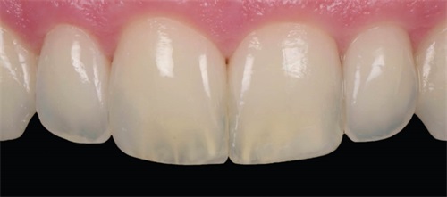 Clinical Case Spotlight: Enhancing Smile Aesthetics Through Precision Layering Dr. Tommaso Mascetti demonstrates a precision layering
technique to achieve seamless shade matching and natural
aesthetics in conservative smile enhancements.