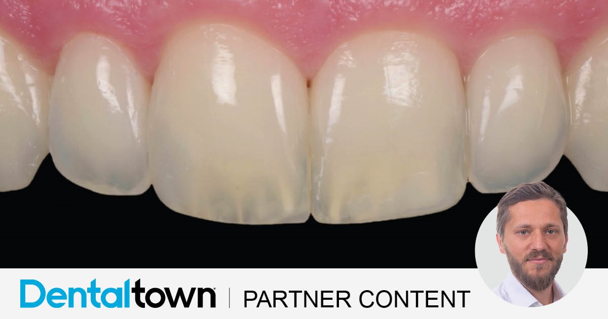 Clinical Case Spotlight: Enhancing Smile Aesthetics Through Precision Layering Dr. Tommaso Mascetti demonstrates a precision layering
technique to achieve seamless shade matching and natural
aesthetics in conservative smile enhancements.