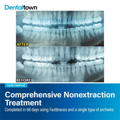 Case Profile: Fastbraces Comprehensive Nonextraction Treatment