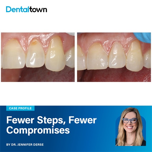 Fewer Steps, Fewer Compromises Dr. Jennifer Derse demonstrates how GrandioSO 4U’s five-shade system and high filler content simplify restorative decisions while delivering natural aesthetics and long-term durability.