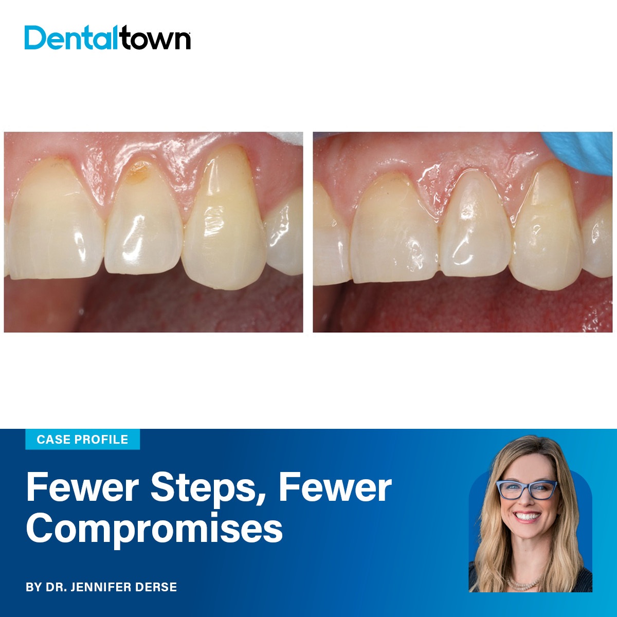 Fewer Steps, Fewer Compromises Dr. Jennifer Derse demonstrates how GrandioSO 4U’s five-shade system and high filler content simplify restorative decisions while delivering natural aesthetics and long-term durability.