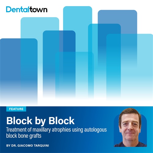 Block by Block Dr. Giacomo Tarquini presents a step-by-step clinical case illustrating the use of intraoral autologous bone block grafts to correct maxillary ridge atrophy and enable successful implant placement.
