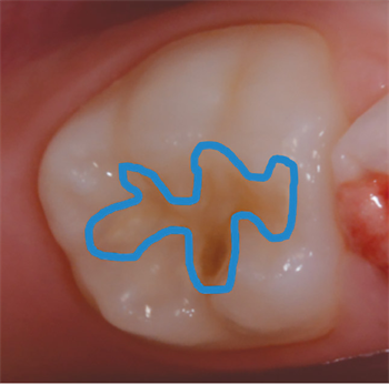 Is It Time to Be Conservative, or Progressive? Dr. Jarod Johnson explores different restorative materials that can be utilized for primary teeth.