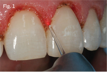 The Dental Laser’s Role in Managing Periodontal Disease Dr. Samuel Low follows the growth of laser use in health care and discusses in detail the periodontal laser.