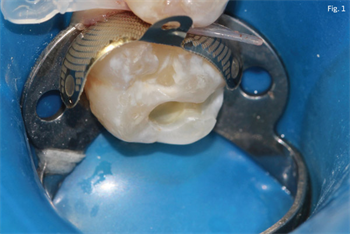 Practice Solutions: Tokuyama Dental Dr. Carla Cohn explains which qualities make a good restorative material in pediatric dentistry