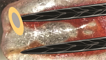 Endodontic Reboot: Part One Drs. Gilberto Debelian, Kenneth Serota and Martin Trope discuss anatomically defined canal disinfection—and why using a round file to clean an ovoid root canal can lead to the failure to debride a large amount of the canal’s contents.