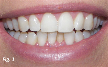 Orthodontist Case Study A Minimally Intrusive Treatment Option