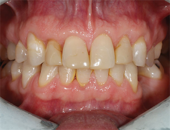 Progressive Bites Dental technician Quint Whipple discusses a progressive bite technique to be used when establishing, restoring or maintaining occlusion.