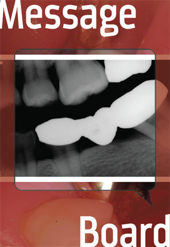 How to Do  a Keyway Bridge  The keyway bridge is used to span an edentulous space while mitigating the stresses destructive to the natural dentition. This case and discussion show the technique and discuss variations.