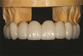 Old School Meets New School Dentaltown board member Dr. John Nosti demonstrates how he uses ceramics instead of metal to create telescopic copings for pier abutments or long-span bridgework with multiple abutments.