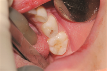 Adhesion in Primary Dentition Restorative Dentistry Dr. Carla Cohn discusses which adhesives work best when working on pediatric patients, and shares two cases that demonstrate her findings and techniques.