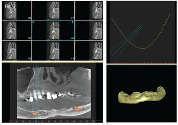 Show Your Work: Restoration Hardware Dr. Andrea Joy Smith shares a case in which she used mini-implants to treat a severely medically compromised patient who wasn’t a candidate for traditional implants, but needed a full-mouth restoration.