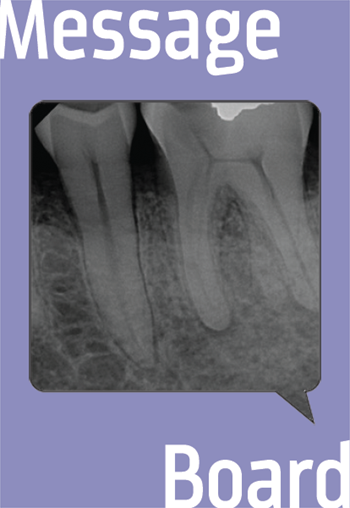 2nd Distal Root on 36 (3rd Root on #19) 