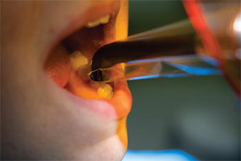 The Best Cure According to an ADA study, half of all dental income relies on the successful use of light-cured materials. Dr. Jed Best explains how dentists can tell if their curing light is functioning properly.