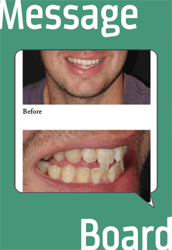 4.5 Year Align, Bleach Bond Review How aligners can have more than aesthetic benefits