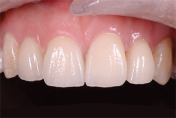Show Your Work  Ceramic Is Not Dead and Occlusion Is Important