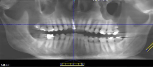 Show Your Work: A Collaborative Effort on 3 Fronts This multidisciplinary treatment plan from Dr. Elizabeth DiBona features elements of digital planning, oral surgery, orthodontics and classic restorative principles. DiBona discusses the case’s various considerations and showcases a collaborative outcome the patient loved.