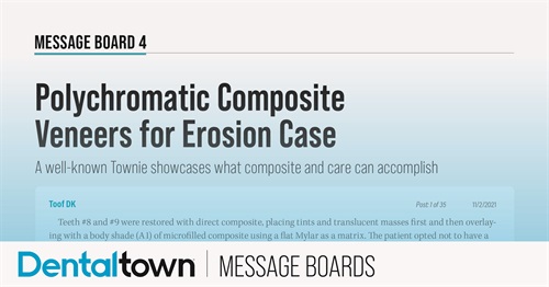Polychromatic Composite Veneers for Erosion Case A well-known Townie showcases what composite and care can accomplish