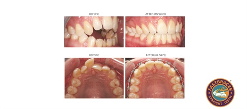 Product Profile: Fastbraces Changing the financial landscape of orthodontics in dentistry