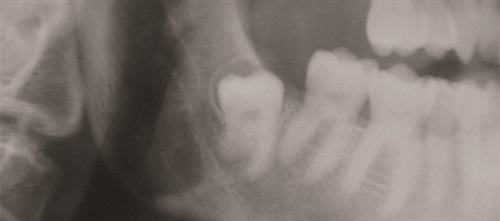 Prophylactic Removal of Third Molars Dr. Jay B. Reznick, an oral surgeon and a member of Dentaltown’s editorial advisory board, examines the cases for and against prophylactic removal of asymptomatic third molars—and how conventional wisdom has changed over the years.