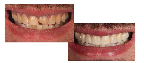 Show Your Work: Full-Contour Veneers and a Fantastic Hygienist Dr. Arthur R. Volker shares a case study of a patient who hadn’t been to a dentist for more than 15 years and came in with
a fractured front tooth.