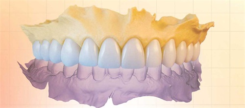Tech-Driven Full-Mouth Rehab Drs. Jarron Tawzer and Josh Nagao present a complex full-mouth rehab, transforming a confused patient’s care journey into a clear, predictable and aesthetically successful outcome.