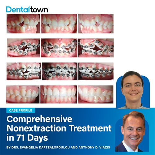 Case Profile: Fastbraces A case report using only Fastbraces brackets and a single archwire