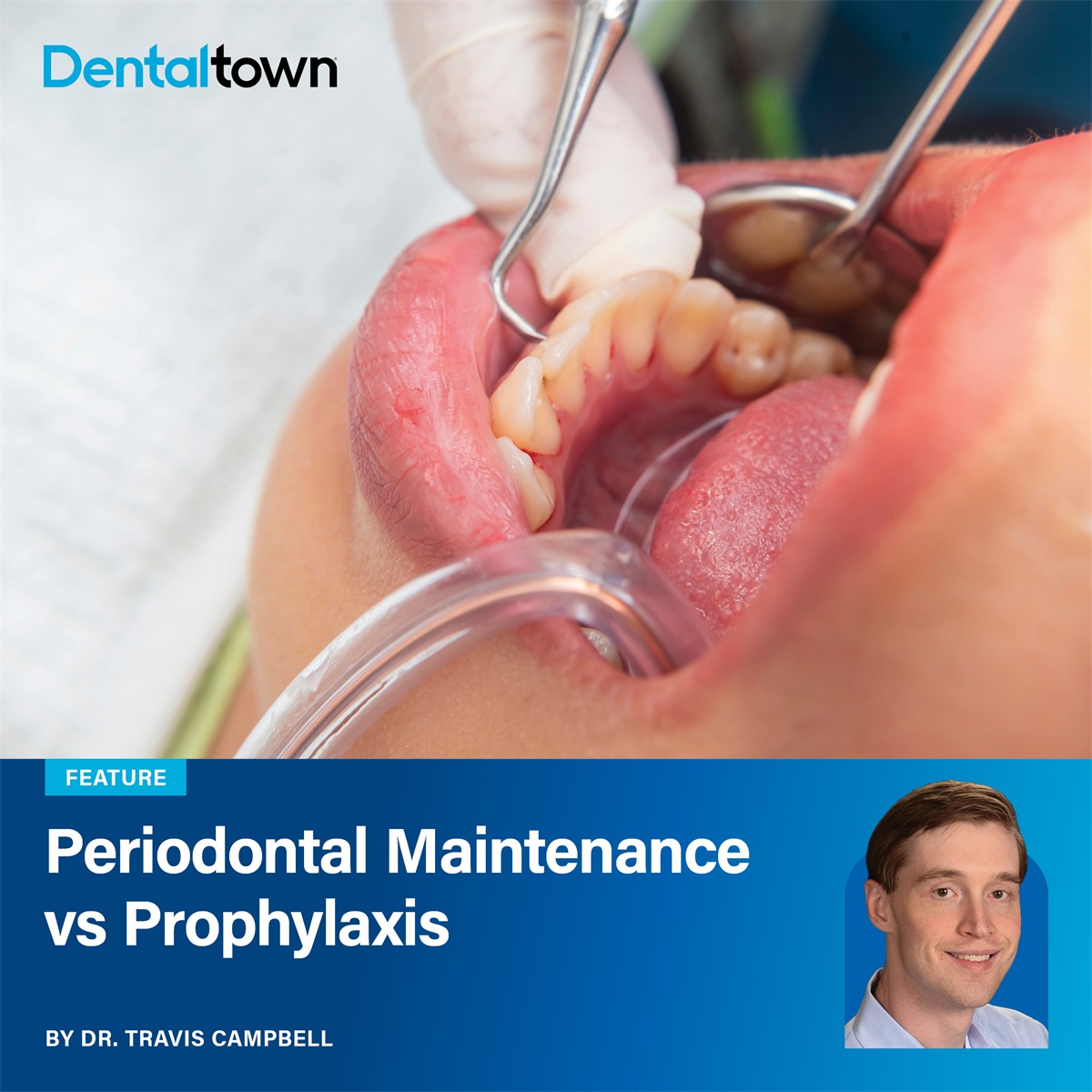 Periodontal Maintenance (PM) vs Prophylaxis (PX)