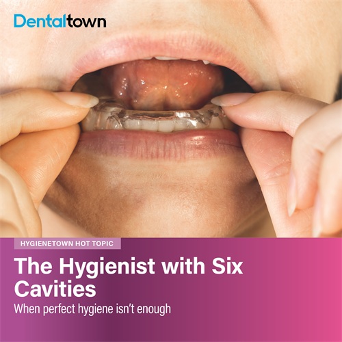 The Hygienist with Six Cavities When a hygienist with excellent oral hygiene presents with multiple cavities, something unusual is going on. The overlooked role of night guards, retainers and aligners in creating an acidic environment that brushing can't fix.