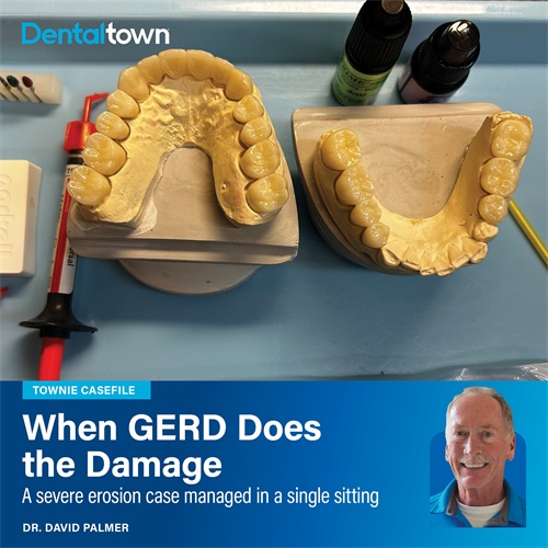 Townie Casefile: When GERD Does the Damage Dr. David Palmer shares a severe full-arch erosion case from caused by acid reflux—not bruxism—is managed in a single extended appointment.