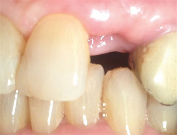 Minimally Invasive Approach: Implant Prosthetics and Aesthetics of a Lateral Incisor  Dr. Francesco Campione writes about using a minimally invasive approach for a prosthetic resolution in this case presentation.