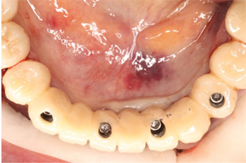 The Strong, Silent Type Drs. Ron Kaminer, Daniel D. Gober and Markus L. Weitz share three different case studies in which organically modified ceramics (ormocers) help seal screw access holes on implant restorations.