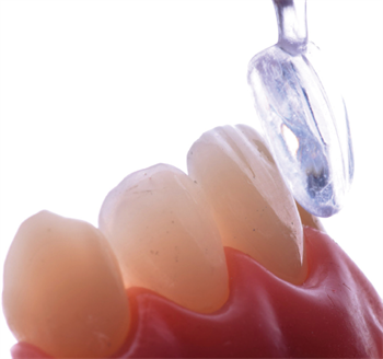 The Direct  Approach Dr. Sigal Jacobson discusses techniques to create great-looking, long-lasting composite veneers.