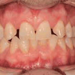 Show Your Work: Replacing Missing Upper Lateral Incisors Dr Andy Toy describes the management of an interesting case that involved two phases of aligners and implants.