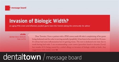 Invasion of Biologic Width? An aging PFM crown and inflamed, purplish gums have this Townie asking the community for advice.