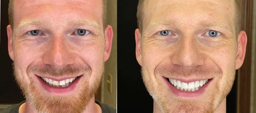 Less Is More: Highly Aesthetic, Minimally Invasive Veneers Improvements in restorative materials and conservative techniques offer clinicians the ability to deliver highly aesthetic results using minimally invasive or no-preparation veneers to restore smiles and even straighten misaligned teeth. Dr. John Heimke explains more and shares a patient case study with a custom-designed smile featuring 18 minimally invasive veneers. 