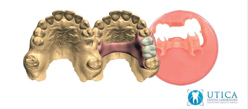 Product Profile: TCS 3D Flexible Partials A complete digital solution for partial dentures from Utica Dental Lab.