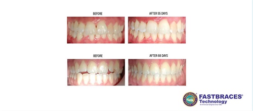 Product Profile: Fastbraces The next generation of orthodontic movement in days