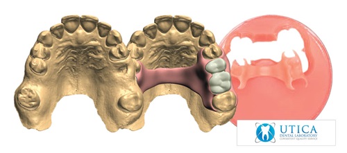 Product Profile: TCS 3D Flexible Partials A complete digital solution for partial dentures