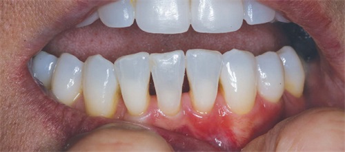 Show Your Work: Filling the Gaps Dr. Robert Rosenfeld shares a case in which he treated the dreaded “black triangles” on a patient’s front teeth, using a specialized matrix kit and a composite with chameleon-like qualities. 