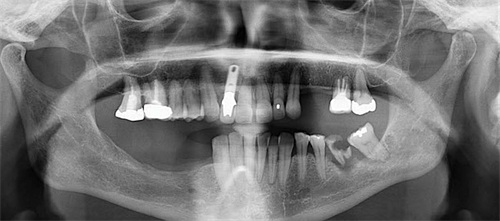 Rescuing a Failed Maxillary Arch with a Pterygoid Implant: A Digital Full-Arch Success Story A failed implant nearly derailed this full-arch case from Drs. Danny Domingue and Cory Glenn—until a digital workflow and pterygoid rescue saved the smile and exceeded patient expectations
