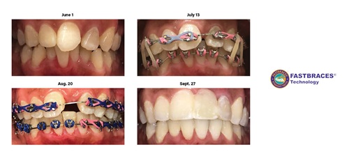Product Profile: Fastbraces Making spaces for implants in about 100 days