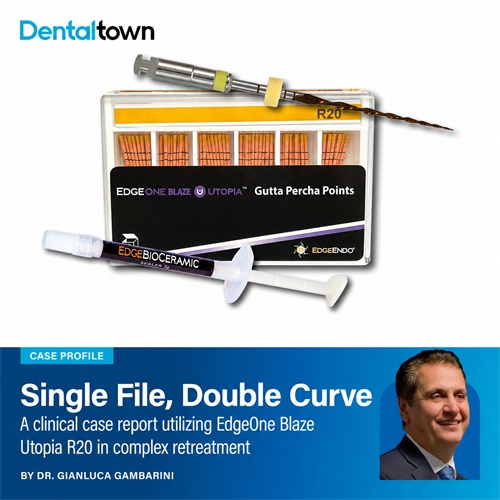 Case Profile: Single File, Double Curve Dr. Gianluca Gambarini details a challenging MB2 retreatment case where the EdgeOne Blaze Utopia R20 navigated a narrow double-curved canal without glide path preparation.