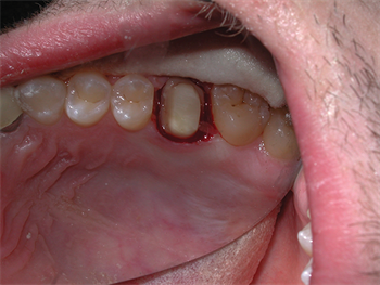 It All Starts with the Prep,  Doctor! Dr. Shalom Mehler shares a case study about PFM (porcelain fused to metal) crowns and how it all “starts with the prep.”