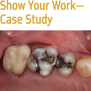 No Shrink? No Stress? No Problem. Direct restoration of posterior teeth using a bulk-fill technique