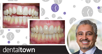 Acceleration Techniques  for Clear Aligner Patients Dr. Payam Ataii discusses how manual osteoperforation acceleration techniques can help speed treatment of patients with clear aligners, and even make the seating of aligners easier.