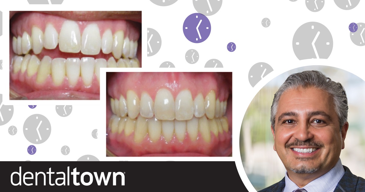 Acceleration Techniques  for Clear Aligner Patients Dr. Payam Ataii discusses how manual osteoperforation acceleration techniques can help speed treatment of patients with clear aligners, and even make the seating of aligners easier.