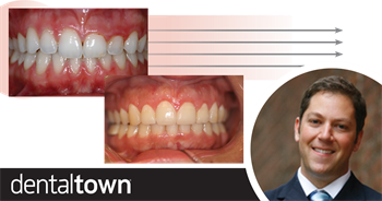 Aesthetic Crown Lengthening In this follow-up to his February 2018 article on functional crown lengthening, Denver periodontist and Dentaltown board member Dr. Brian Gurinsky explains why you should lengthen a crown for aesthetic reasons. 